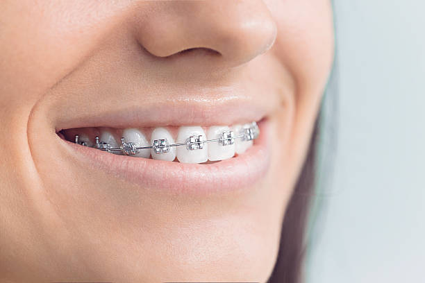 Dental Inlays and Onlays in Chackbay, LA